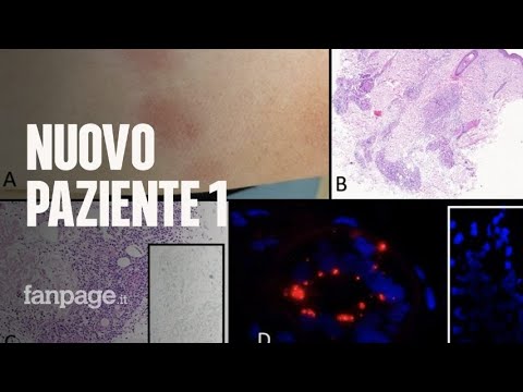 Covid, scoperto nuovo paziente 1 italiano: è una donna milanese positiva a novembre 2019