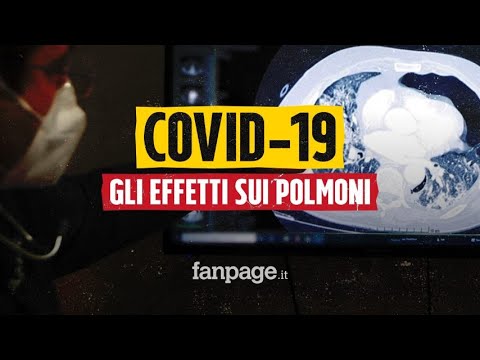 Cosa c’è nei polmoni di un paziente affetto da Covid-19. Il medico: “Ricoverati dai 30 anni in su”