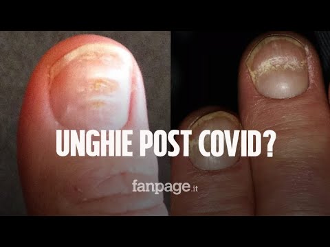 Questi segni sulle unghie possono indicare che hai avuto il Covid: cosa sono le linee di Beau