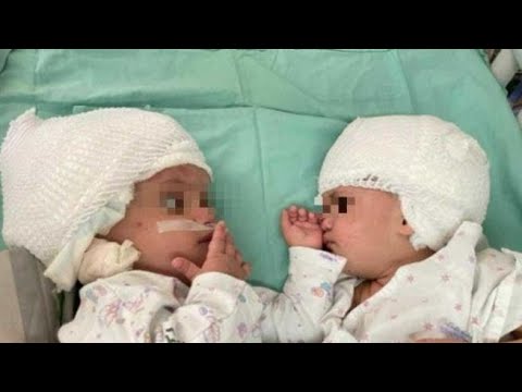 Israele, il primo sguardo tra le gemelline separate dopo 12 ore di operazione