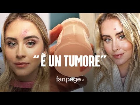 Valentina Ferragni: “Ho un tumore maligno della pelle, è molto raro”