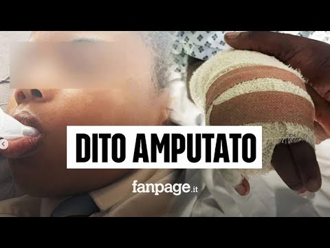 Si ferisce per sfuggire ai bulli razzisti, amputato dito a bimbo di 11 anni