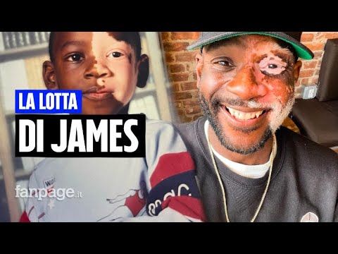“Da bambino mi chiamavano mostro”: la forza di James, che lotta per un mondo più inclusivo