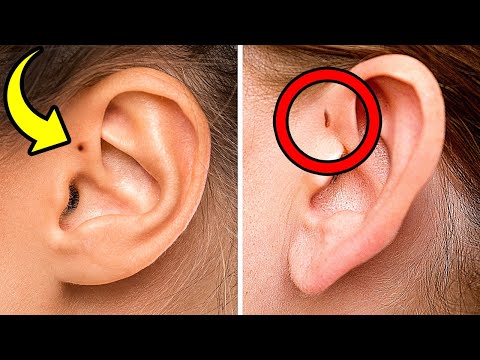 Le Nostre Orecchie Possono Renderci Unici + 10 Rare Condizioni Fisiche