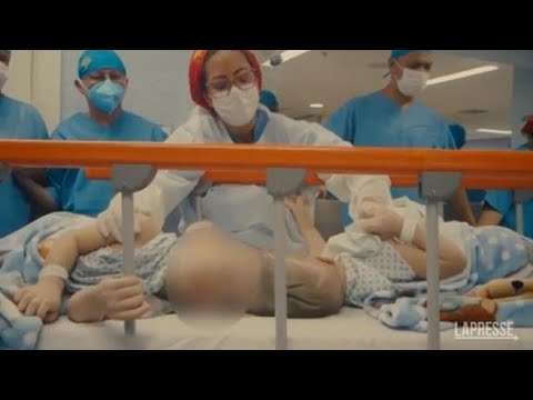 Brasile, separati i gemelli siamesi attaccati dalla testa: l’operazione durata 27 ore