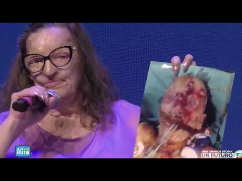 «Ditemi voi se questi si possono definire maltrattamenti»: Filomena, sfregiata con l’acido dal…