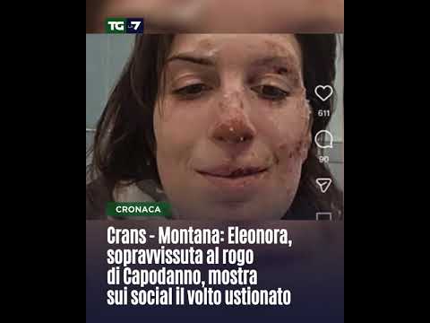 Crans Montana: Eleonora, sopravvissuta al rogo di Capodanno, mostra sui social il volto ustionato